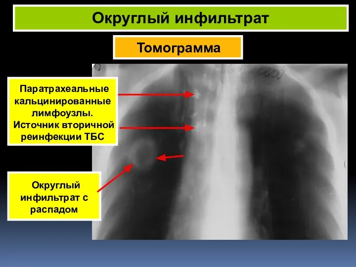 Томограмма Округлый инфильтрат Округлый инфильтрат с распадом Паратрахеальные кальцинированные лимфоузлы. Источник вторичной реинфекции ТБС