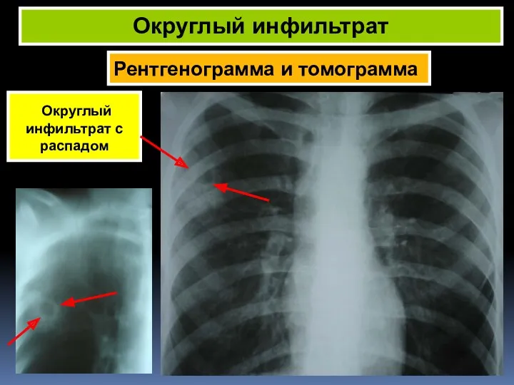 Рентгенограмма и томограмма Округлый инфильтрат Округлый инфильтрат с распадом