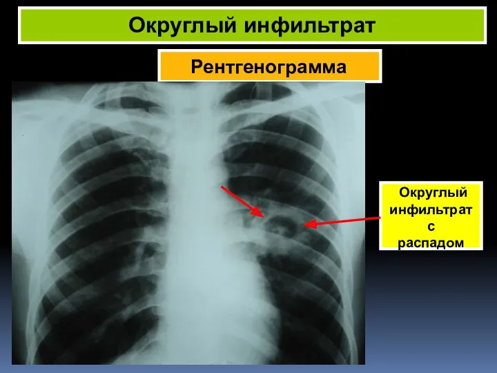 Рентгенограмма Округлый инфильтрат Округлый инфильтрат с распадом