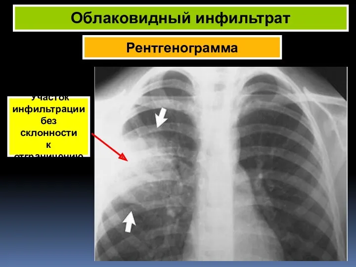 Рентгенограмма Облаковидный инфильтрат Участок инфильтрации без склонности к отграничению
