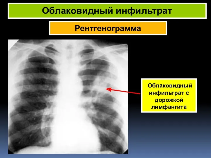 Рентгенограмма Облаковидный инфильтрат Облаковидный инфильтрат с дорожкой лимфангита