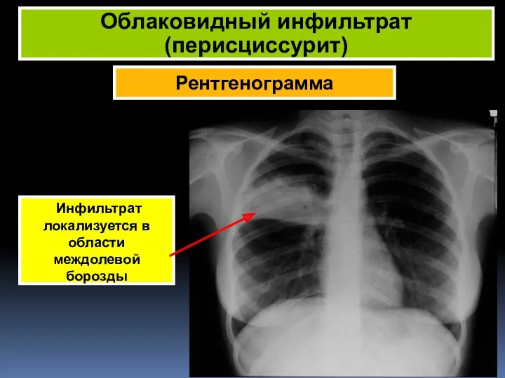 Рентгенограмма Облаковидный инфильтрат (перисциссурит) Инфильтрат локализуется в области междолевой борозды