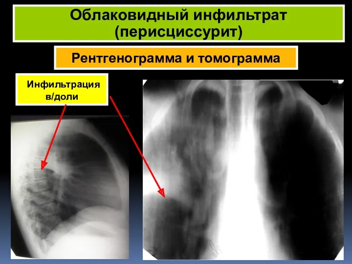 Рентгенограмма и томограмма Облаковидный инфильтрат (перисциссурит) Инфильтрация в/доли
