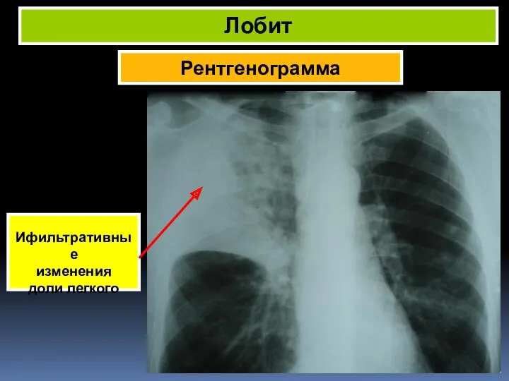 Рентгенограмма Лобит Ифильтративные изменения доли легкого