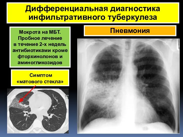 Пневмония Дифференциальная диагностика инфильтративного туберкулеза Симптом «матового стекла» Мокрота на МБТ. Пробное лечение