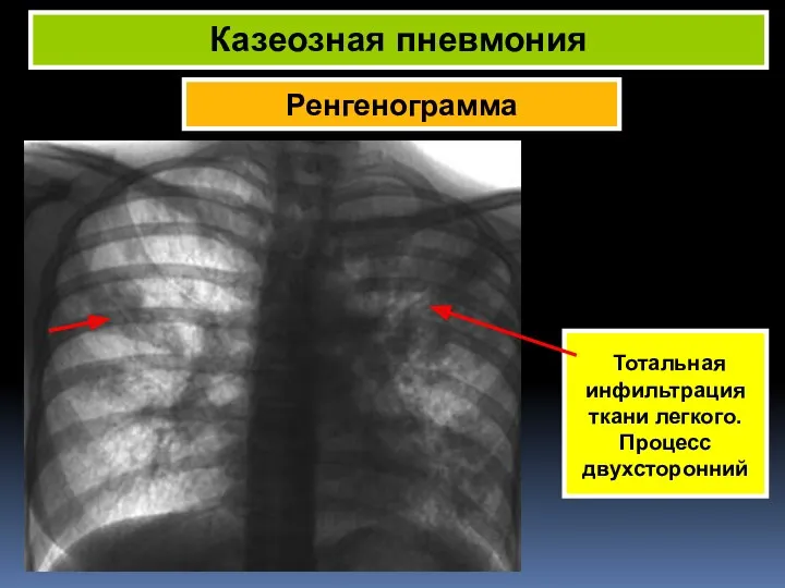Ренгенограмма Казеозная пневмония Тотальная инфильтрация ткани легкого. Процесс двухсторонний