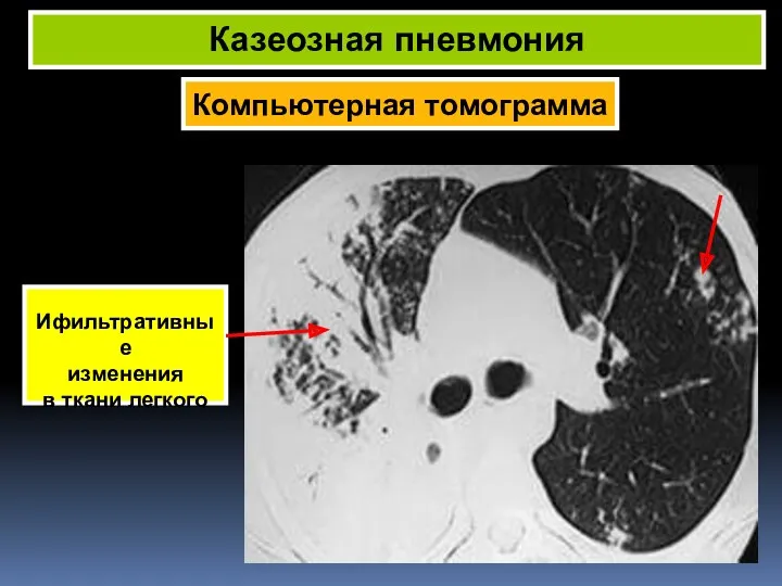 Компьютерная томограмма Казеозная пневмония Ифильтративные изменения в ткани легкого