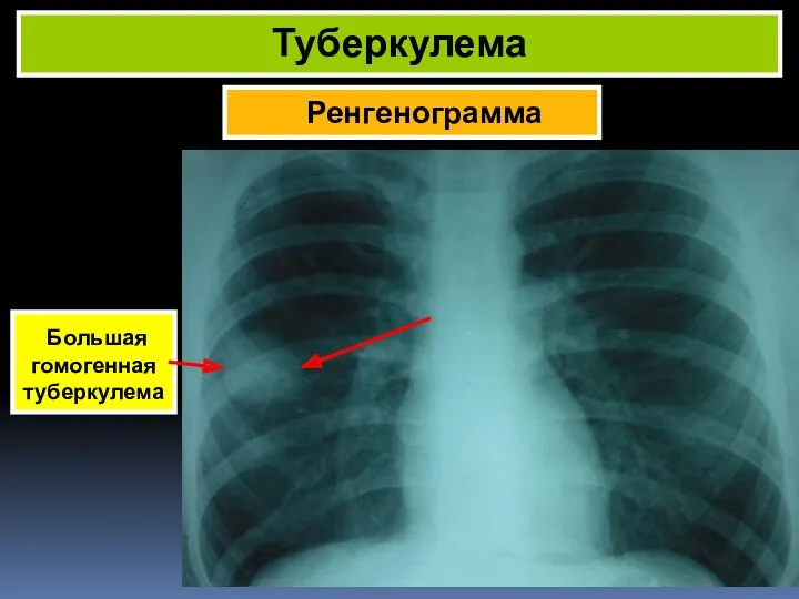 Ренгенограмма Туберкулема Большая гомогенная туберкулема