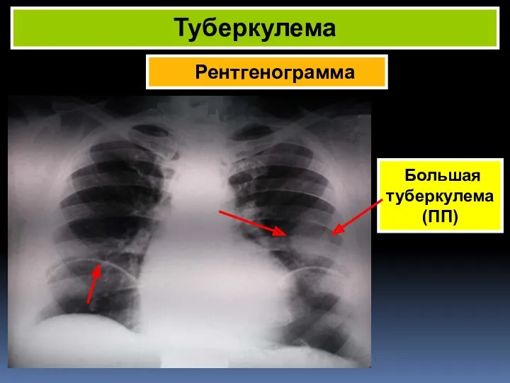 Рентгенограмма Туберкулема Большая туберкулема (ПП)