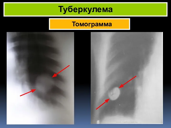 Томограмма Туберкулема