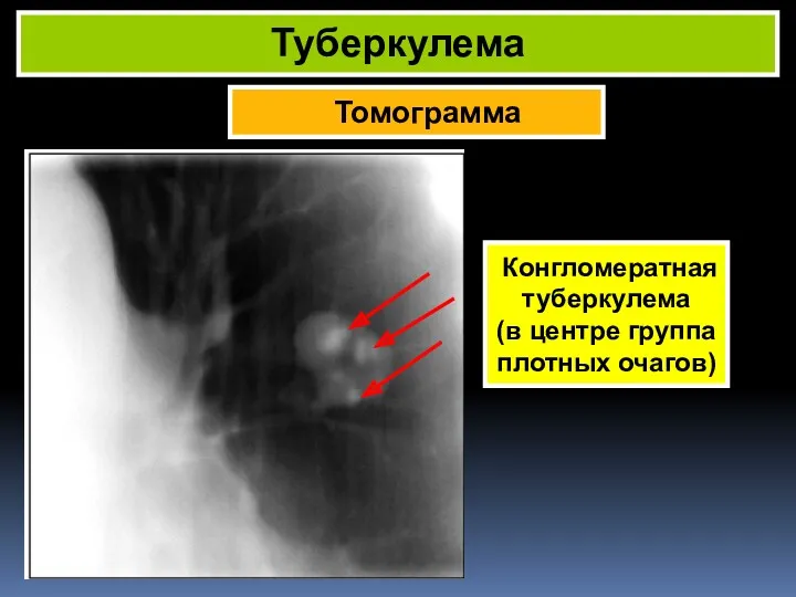 Томограмма Туберкулема Конгломератная туберкулема (в центре группа плотных очагов)