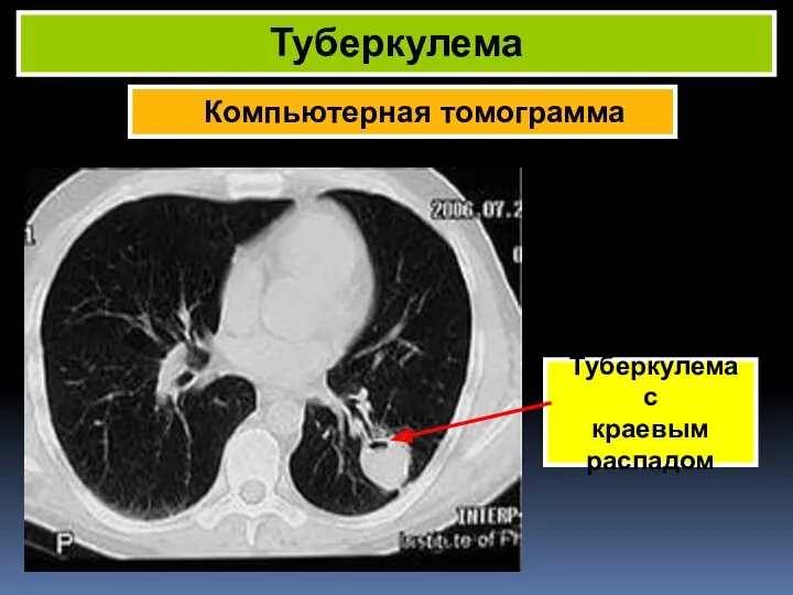 Компьютерная томограмма Туберкулема Туберкулема с краевым распадом