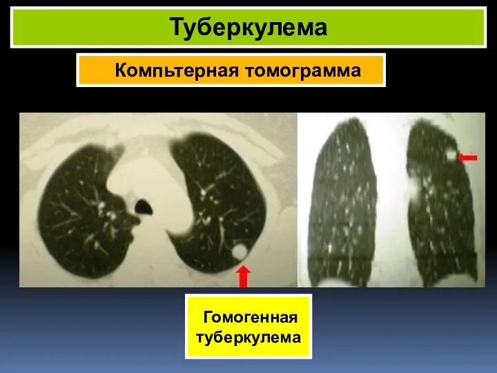 Компьтерная томограмма Туберкулема Гомогенная туберкулема