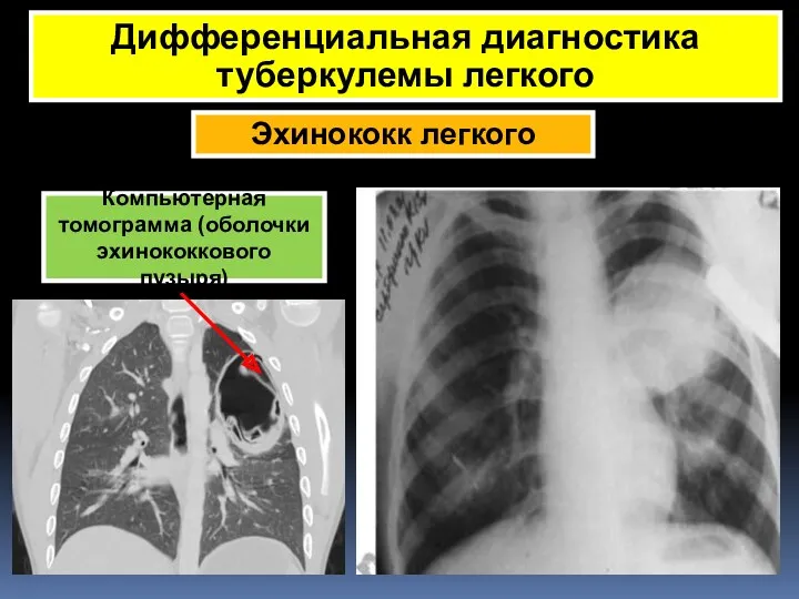 Эхинококк легкого Дифференциальная диагностика туберкулемы легкого Симптом «матового стекла» Компьютерная томограмма (оболочки эхинококкового пузыря)