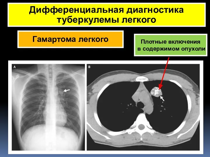 Гамартома легкого Дифференциальная диагностика туберкулемы легкого Симптом «матового стекла» Плотные включения в содержимом опухоли