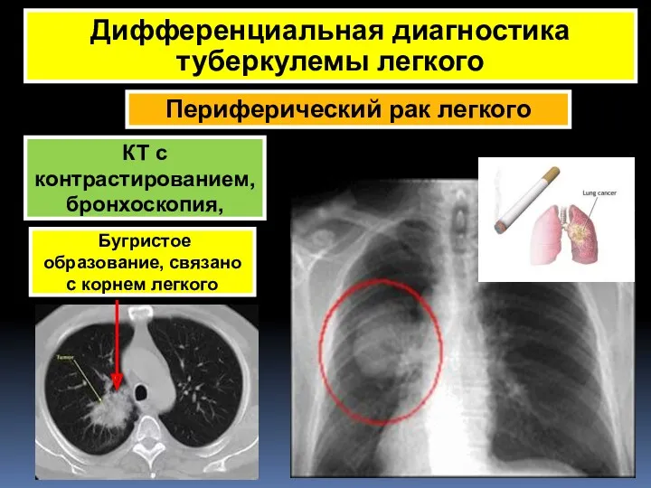 Периферический рак легкого Дифференциальная диагностика туберкулемы легкого Бугристое образование, связано с корнем легкого