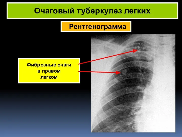 Рентгенограмма Очаговый туберкулез легких Фиброзные очаги в правом легком