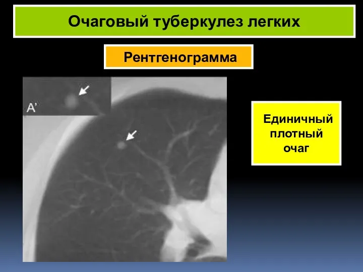 Единичный плотный очаг Очаговый туберкулез легких Рентгенограмма