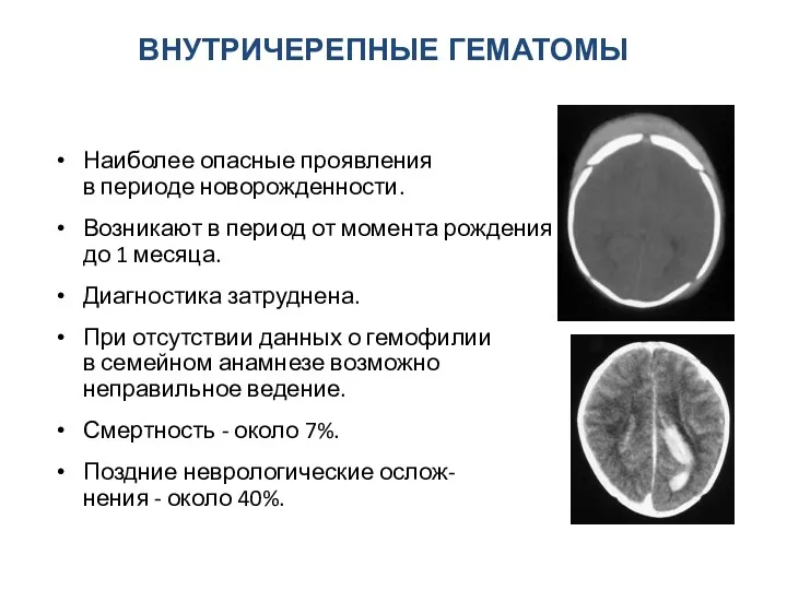 ВНУТРИЧЕРЕПНЫЕ ГЕМАТОМЫ Наиболее опасные проявления в периоде новорожденности. Возникают в