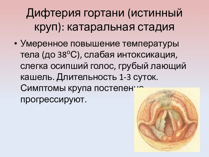 Дифтерия гортани (истинный круп): катаральная стадия Умеренное повышение температуры тела