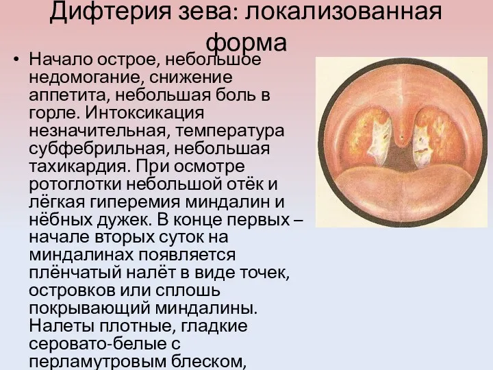 Дифтерия зева: локализованная форма Начало острое, небольшое недомогание, снижение аппетита,