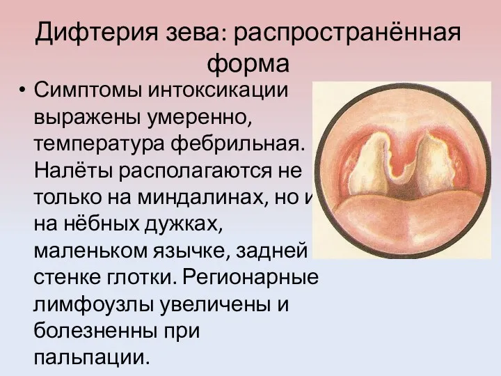 Дифтерия зева: распространённая форма Симптомы интоксикации выражены умеренно, температура фебрильная.