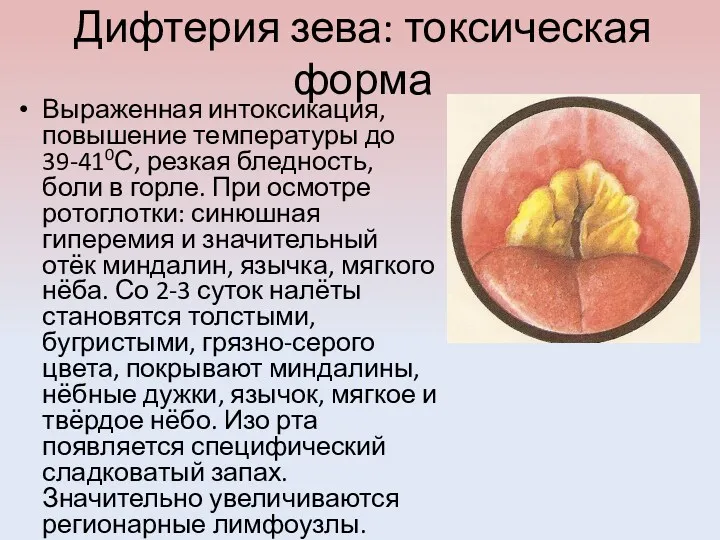 Дифтерия зева: токсическая форма Выраженная интоксикация, повышение температуры до 39-410С,