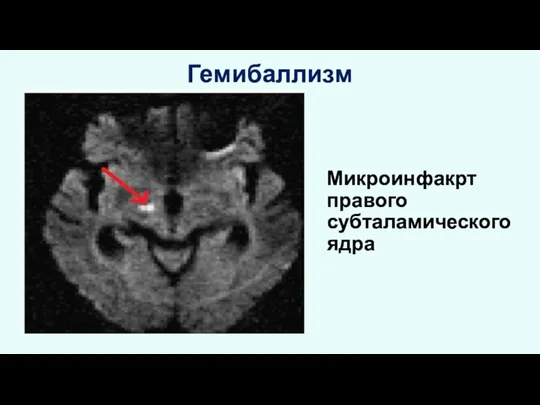 Гемибаллизм Микроинфакрт правого субталамического ядра