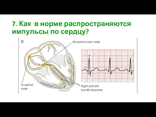7. Как в норме распространяются импульсы по сердцу?