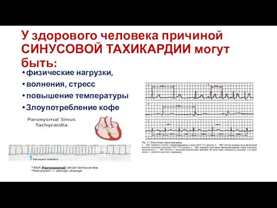 У здорового человека причиной СИНУСОВОЙ ТАХИКАРДИИ могут быть: физические нагрузки, волнения, стресс повышение температуры Злоупотребление кофе