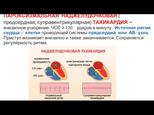 ПАРОКСИЗМАЛЬНАЯ НАДЖЕЛУДОЧКОВАЯ ( предсердная, суправентрикулярная) ТАХИКАРДИЯ – внезапное ускорение ЧСС