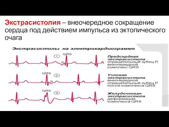 Экстрасистолия – внеочередное сокращение сердца под действием импульса из эктопического очага