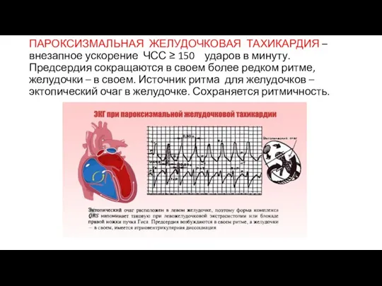 ПАРОКСИЗМАЛЬНАЯ ЖЕЛУДОЧКОВАЯ ТАХИКАРДИЯ – внезапное ускорение ЧСС ≥ 150 ударов