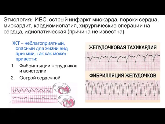 Этиология: ИБС, острый инфаркт миокарда, пороки сердца, миокардит, кардиомиопатия, хирургические