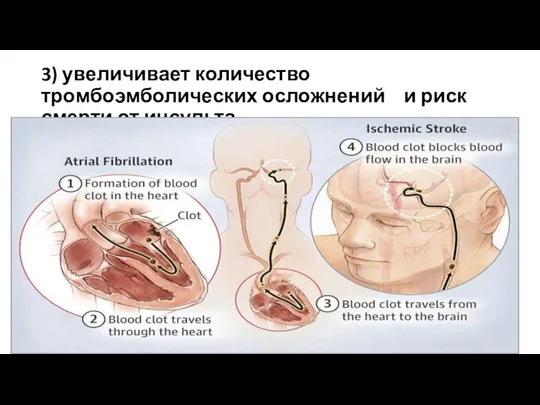 3) увеличивает количество тромбоэмболических осложнений и риск смерти от инсульта