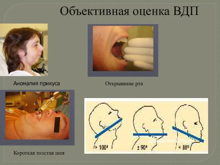 Объективная оценка ВДП Аномалия прикуса Открывание рта Движения головы Короткая толстая шея
