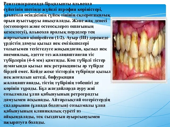 Рентгенограммада бірқалыпты альвеола сүйегінің шетінде жүйелі атрофия көріністері, альвеола өсіндісінің