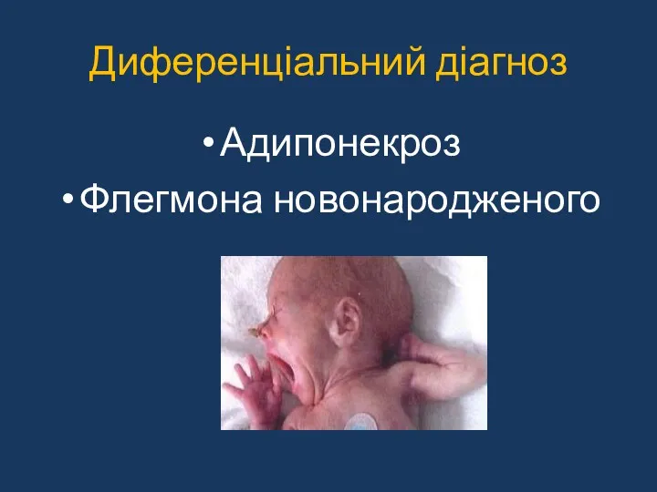 Диференціальний діагноз Адипонекроз Флегмона новонародженого
