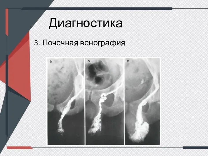 Диагностика 3. Почечная венография