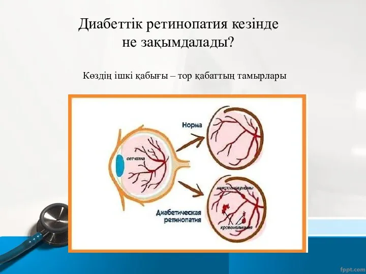 Диабеттік ретинопатия кезінде не зақымдалады? Көздің ішкі қабығы – тор қабаттың тамырлары