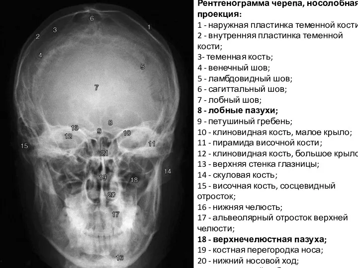 Рентгенограмма черепа, носолобная проекция: 1 - наружная пластинка теменной кости; 2 - внутренняя