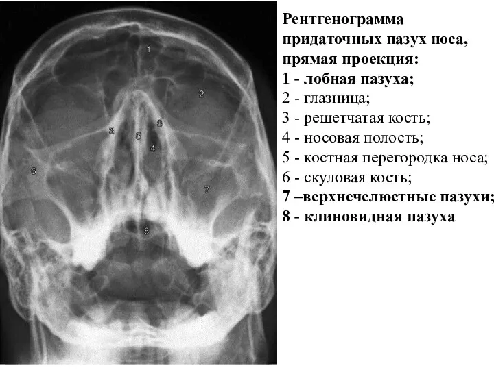 Рентгенограмма придаточных пазух носа, прямая проекция: 1 - лобная пазуха; 2 - глазница;