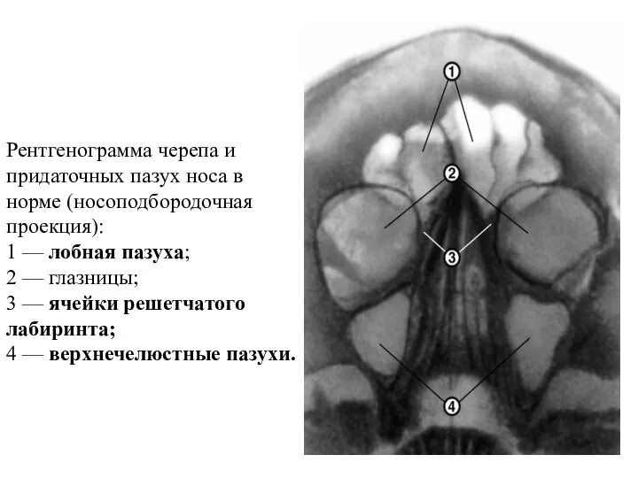 Рентгенограмма черепа и придаточных пазух носа в норме (носоподбородочная проекция): 1 — лобная