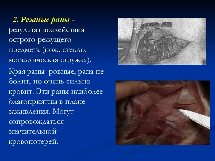 2. Резаные раны - результат воздействия острого режущего предмета (нож,