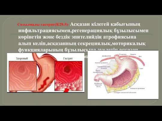 Созылмалы гастрит(К29.5)- Асқазан кілегей қабығының инфильтрациясымен,регенерациялық бұзылысымен көрінетін және бездік