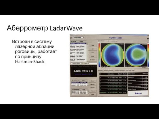 Аберрометр LadarWave Встроен в систему лазерной аблации роговицы, работает по принципу Нartman-Shack.