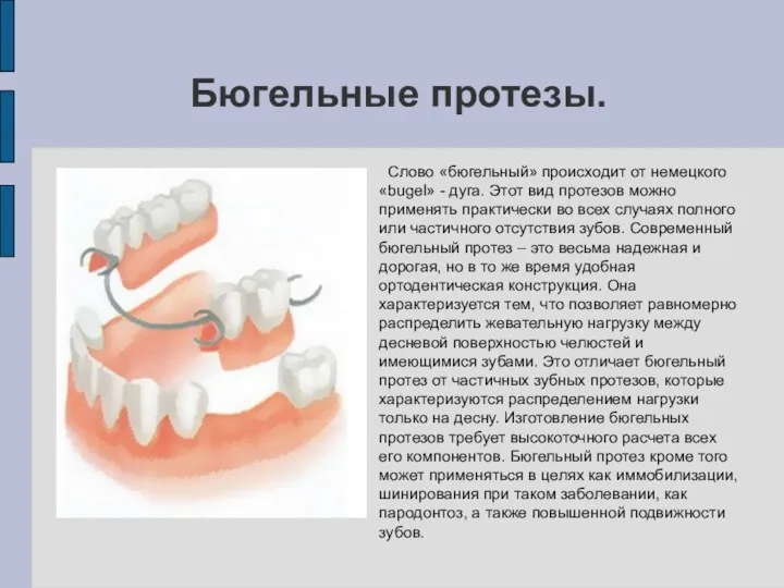 Бюгельные протезы. Слово «бюгельный» происходит от немецкого «bugel» - дуга.