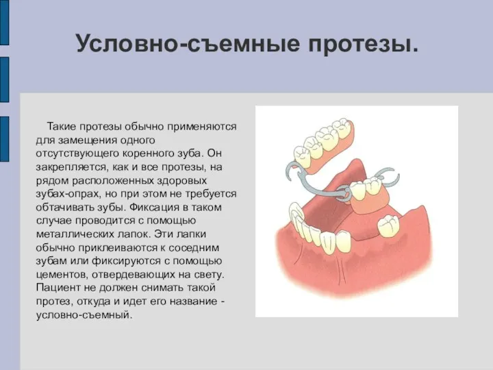 Условно-съемные протезы. Такие протезы обычно применяются для замещения одного отсутствующего