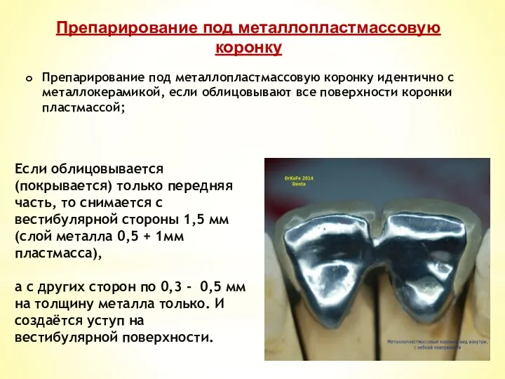 Препарирование под металлопластмассовую коронку идентично с металлокерамикой, если облицовывают все