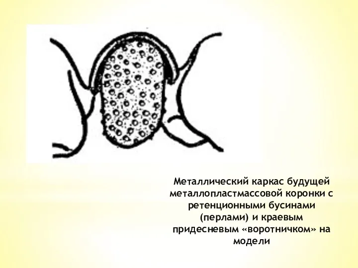 Металлический каркас будущей металлопластмассовой коронки с ретенционными бусинами (перлами) и краевым придесневым «воротничком» на модели